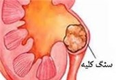 کشف داروی جدید برای دفع راحت‌تر "سنگ کلیه"