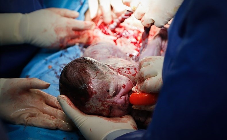 سزارین , وزارت بهداشت , بهداشت و درمان , 