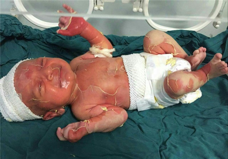 ورود دادستان به موضوع سوختگی نوزاد  صومعه سرایی در بیمارستان/ اعلام نتیجه آزمایش پزشکی قانونی هفته آینده