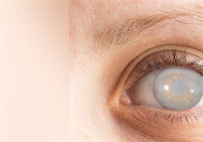 آب مروارید از علل اصلی نابینایی/دلایل نابینایی چیست؟