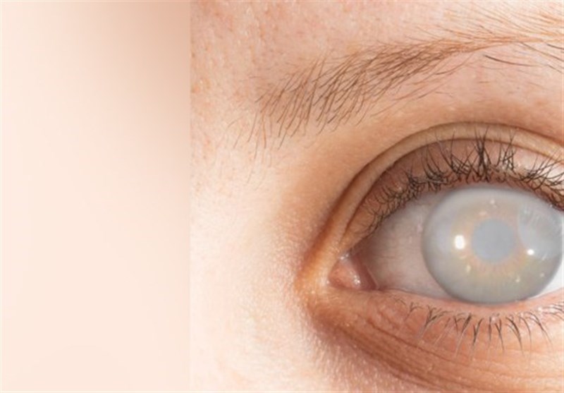 آب مروارید از علل اصلی نابینایی/دلایل نابینایی چیست؟