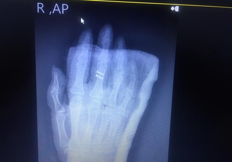 روز خبرنگار , واکسن کرونا ,