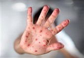 اخبار پزشکی|رشد بی‌سابقه آمار ابتلا به سرخک در آمریکا