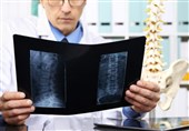 افزایش آمار پوکی استخوان در کشور با رشد سالمندی جمعیت/ 3 شکستگی شایع و خطرناک در بیماران