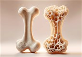 وقوع سالانه 150 هزار مورد شکستگی ناشی از پوکی استخوان در ایران
