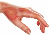 بیش از 50 درصد سوختگی‌ها قابل کنترل و درمان است