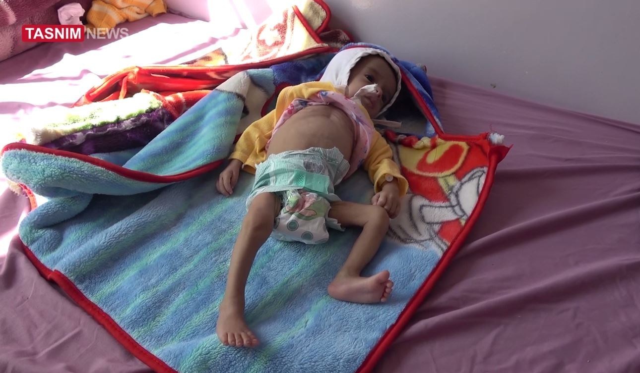 اليمن , سوء التغذية الحاد يهدد الأطفال في اليمن , المجاعة في اليمن , سوء التغذية في اليمن , حركة أنصار الله اليمنية , الأمم المتحدة , العدوان الصهيوأمريكي على اليمن , القوات اليمنية , صنعاء , 