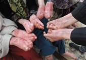 زندگی با تاول‌های بی‌درمان و چالش بیماران پروانه‌ای