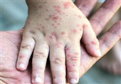 پویش ملی واکسیناسیون سرخجه و اوریون در کیش اجرا می‌شود