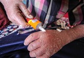 رنج پنهان بیماران پروانه‌ای همدان؛ وقتی بار حمایت بر دوش خیران مانده